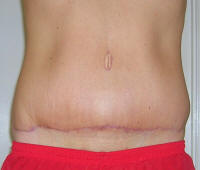Tummy Tuck Scars After 2 Months