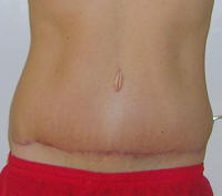 Tummy Tuck Scars After 2 Months And 2 Weeks