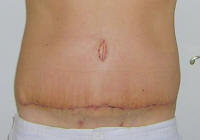 Tummy Tuck Scars After 14 Days