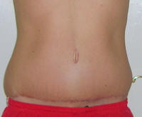 Tummy Tuck Scars After 3 Months And 2 Weeks