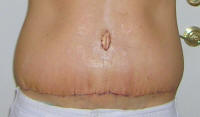 Tummy Tuck Scar Photos, Tummy Tuck Scars After 7 Days