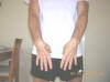 Muscle Atrophy and Weakness in Hand and Fingers Due to Pinched Ulnar Nerve