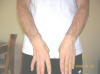 Muscle Atrophy and Weakness in Hand and Fingers Due to Pinched Ulnar Nerve