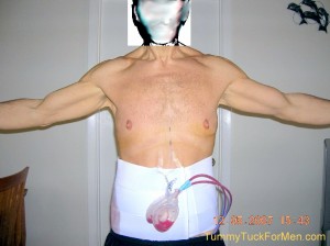 tummy-tuck-abdominoplasty-front-side-after-one-day
