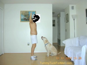 tummy-tuck-abdominoplasty-right-view-after-one-week
