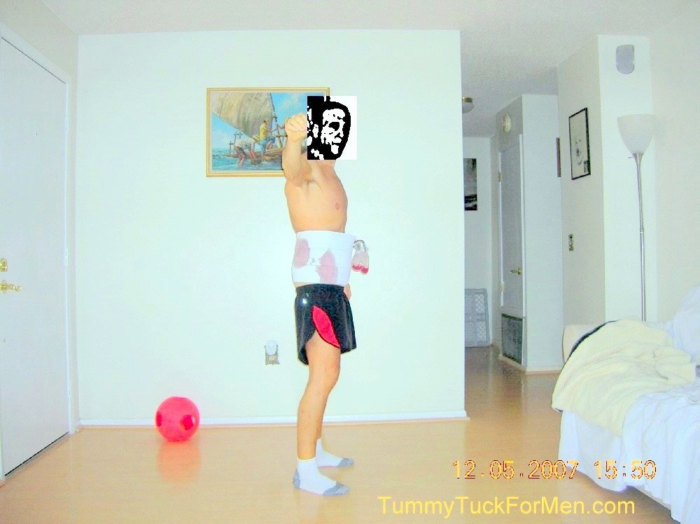 Day After Tummy Tuck Surgery - Tummy Tuck For Men