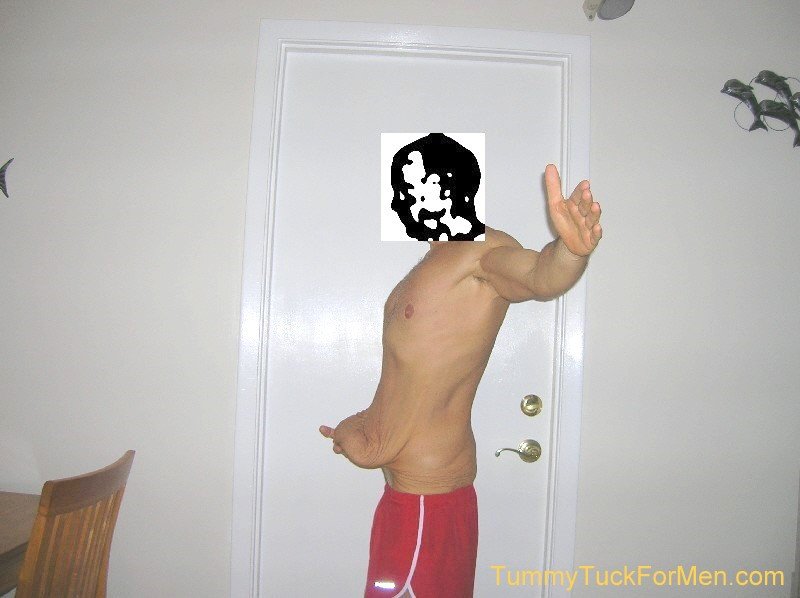 Excess Skin Before Tummy Tuck Surgery - Tummy Tuck For Men