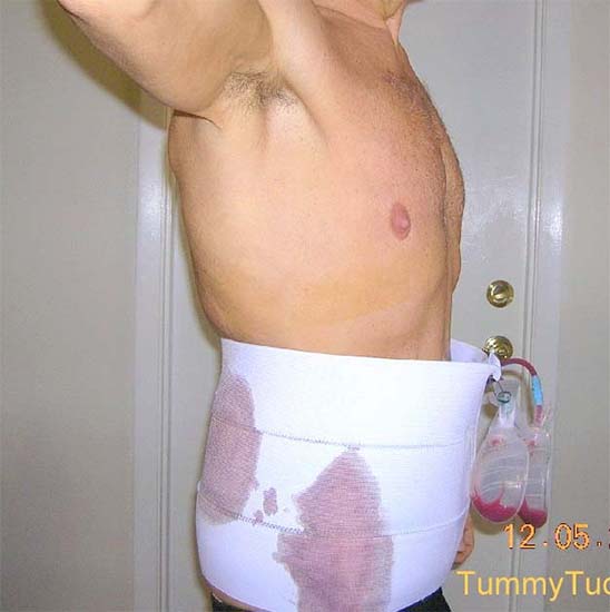 tummy tuck for men – home Tummy Tuck for Men after surgery